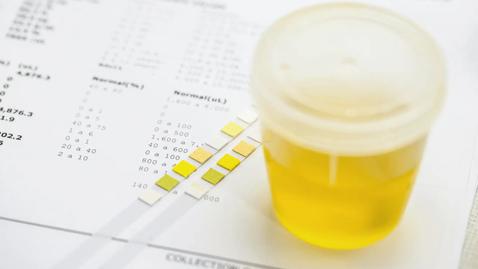 Kálcium-oxalát vizeletvizsgálat vesekő esetén